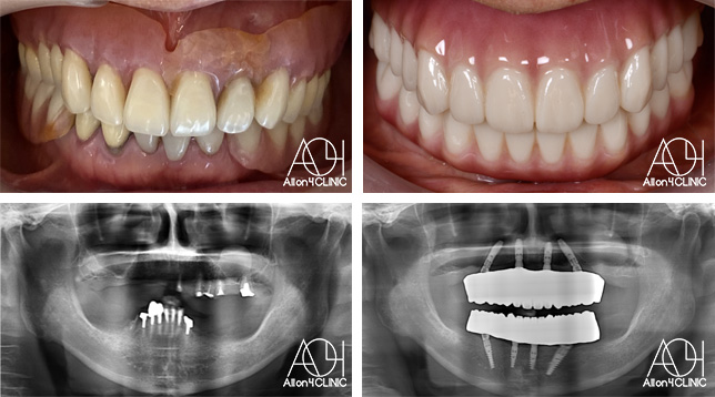 オールオン4症例画像1