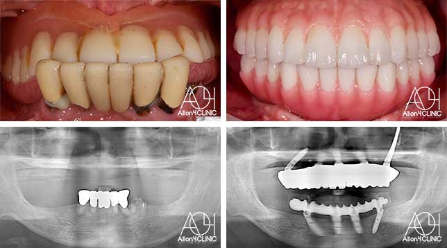 オールオン4症例画像4