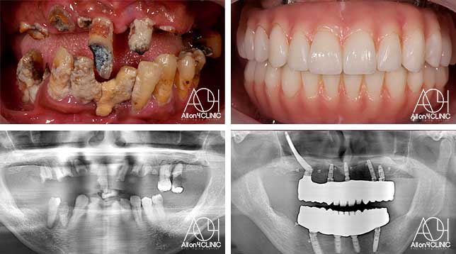 オールオン4症例画像3