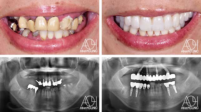 オールオン4症例画像2