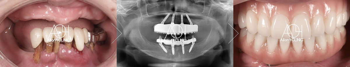 オールオン４の流れ