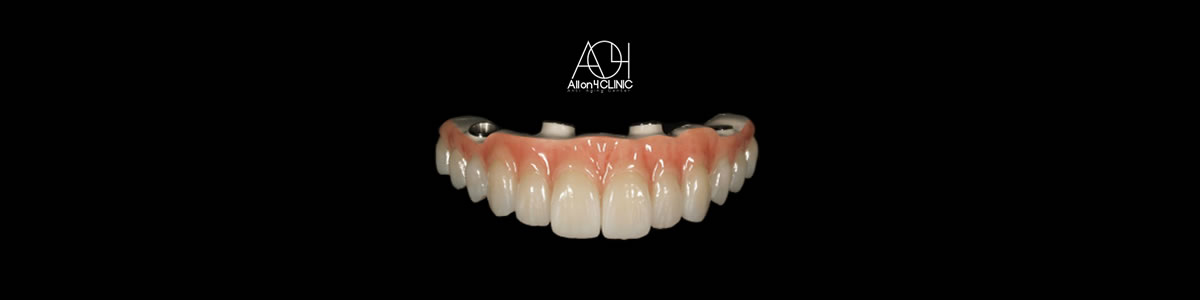 オールオン４ CLINIC銀座 は、世界最高峰のフルブリッジで最高の笑顔を取り戻します。