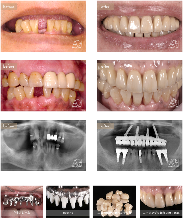 上顎All-on-4。上顎上部構造は二重冠構造（歯肉：アクリリックレジン／歯：セラミック）を採用。上顎の上部構造は、下顎に合わせエイジングを細部に渡り再現。