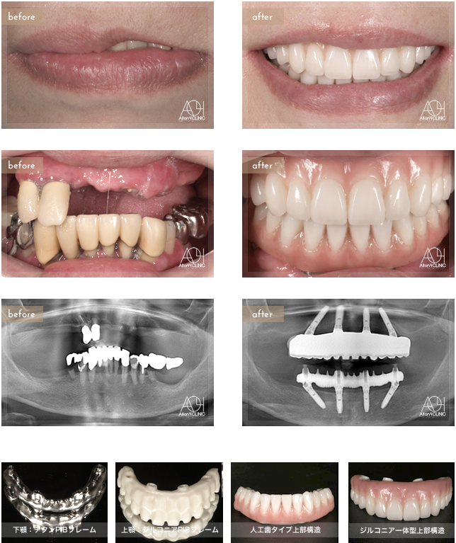 重度歯周病により、全顎的All-on-4による治療。上顎上部構造はジルコニア一体型（歯肉：セラミック／歯：セラミック／ジルコニアPIBフレームに歯肉・歯ともにセラミックを築成）を採用。下顎は人工歯タイプを採用。上顎はジルコニアPIBフレーム。下顎はチタンPIBフレーム。