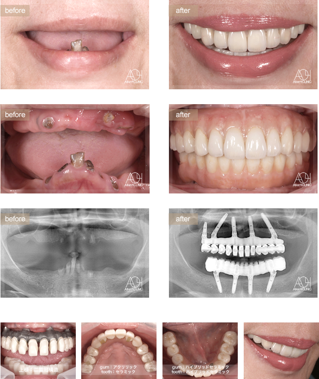 上顎は5本のインプラントを埋入。下顎はAll-on-4。
上顎上部構造は二重冠構造(歯肉:アクリリックレジン歯:セラミック)を採用。
下顎はハイブリッドタイプ(歯肉:ハイブリッドセラミック歯:ハイブリッドセラミック)。 上顎はチタンPIBフレーム。下顎チタンPIBフレーム。
