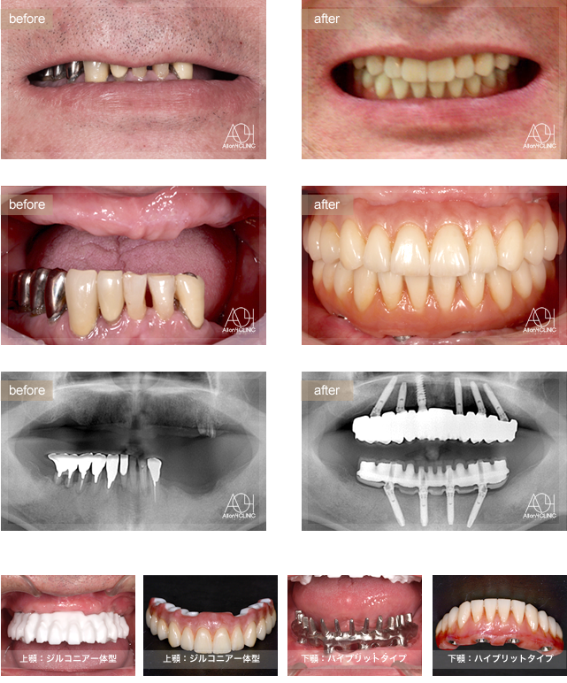 上顎は6本のインプラントを埋入。下顎はAll-on-4。
上顎上部構造はジルコニア一体型。(歯肉:セラミック歯:セラミック)を採用。
下顎はハイブリッドタイプ(歯肉:ハイブリッド基底面のみセラミック処理歯:ハイブリッド)