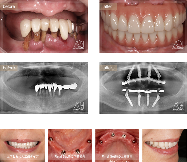 上下All-on-4。上下ともに人工歯タイプ。