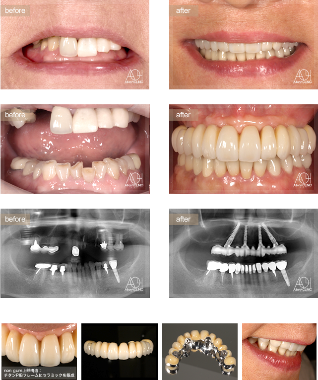上顎All-on-4 non gumタイプ。上顎上部構造はチタンハイブリッドを採用（チタンPIBフレームにハイブリッドセララミックを築成）。コネクティブティッシュグラフトにより歯肉のマネージメントを行う。