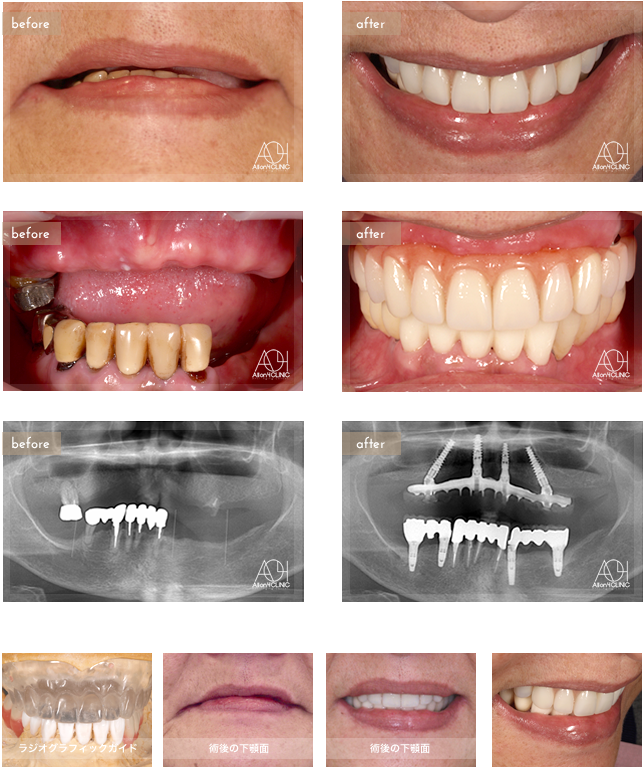 上顎はNobel Active4本を埋入。上部構造はチタンPIBフレーム、人工歯タイプを採用。