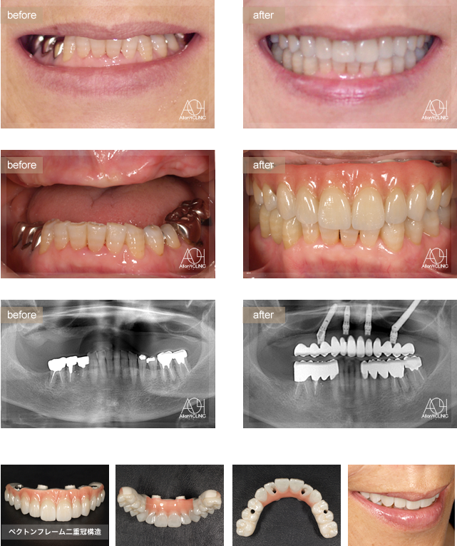上顎左側後方Zygomaインプラントを使用。上顎上部構造はペクトンフレーム、
二重冠構造（歯肉：アクリリックレジン　歯：フルジルコニア）を採用。