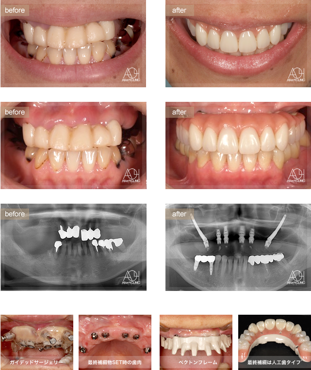 上顎両側Zygoma、前方４本のNobel Activeインプラントを使用。
上顎上部構造はペクトンフレーム（歯肉：アクリリックレジン　歯：人工歯）を採用。