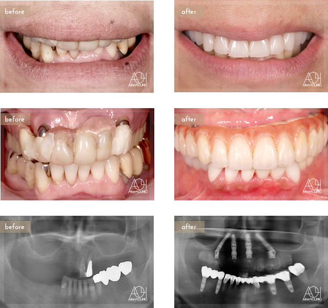 上顎は5本のインプラントを埋入。上顎上部構造はチタンPIBフレーム人工歯タイプ(歯肉:アクリリックレジン 歯:人工歯)