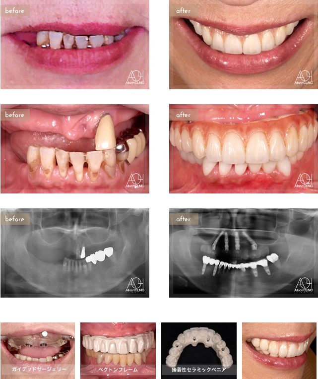 上顎は4本のNobel Activeインプラントを埋入。上顎上部構造はペクトンフレーム(歯肉:アクリリックレジン　歯:接着性セラミックベニア)