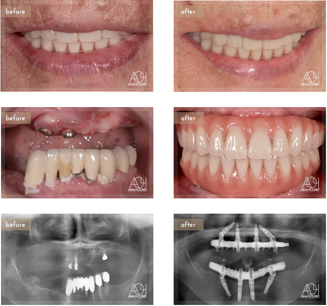 上顎は4本のNobel Activeインプラント、下顎は前方Nobel Active、後方Speedy groovyを埋入。上部構造はチタンPIBフレーム人工歯タイプ(歯肉:アクリリックレジン　歯:人工歯)
上顎は4本のNobel Activeインプラント、下顎は前方Nobel Active、後方Speedy groovyを埋入。上部構造はチタンPIBフレーム人工歯タイプ(歯肉:アクリリックレジン 歯:人工歯)