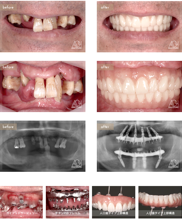 上顎は6本のNobel Activeインプラントを、 下顎はSpeedy Groovyを埋入。上下とも上部構造はチタンPIBフレーム人工歯タイプ (歯肉:アクリリックレジン　歯:人工歯)