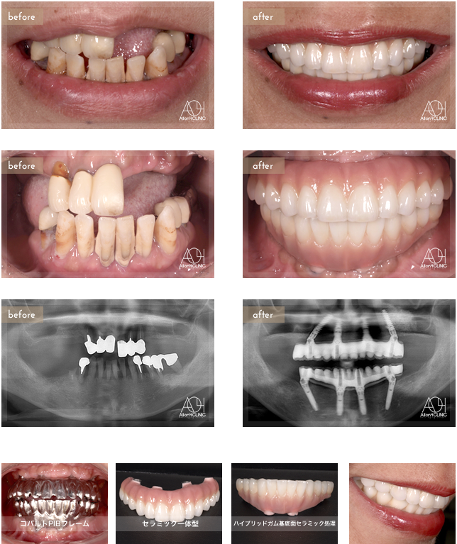 上顎はNobel Active、下顎Speedy Groovy インプラントを埋入。上顎上部構造はコバルトPIBフレームセラミック一体型。下顎はコバルトPIBフレーム(歯肉:ハイブリッドガム基底面セラミック接着処理　歯:ハイブリッド)