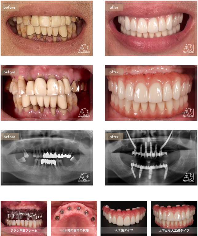 上顎はNobel Active、下顎Speedy Groovy インプラントを埋入。上顎上部構造はコバルトPIBフレームセラミック一体型。下顎はコバルトPIBフレーム(歯肉:ハイブリッドガム基底面セラミック接着処理　歯:ハイブリッド)