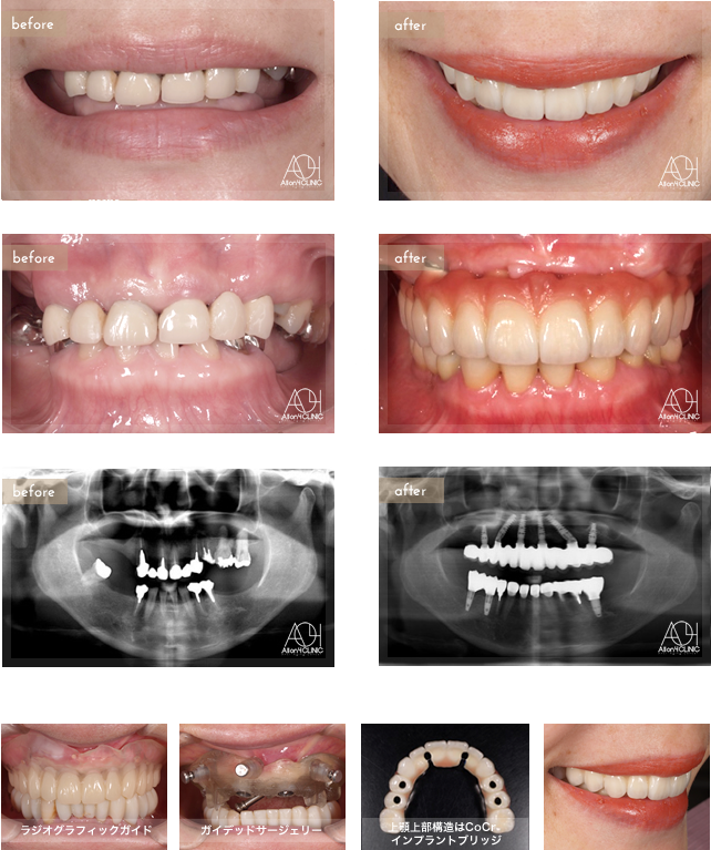 上顎はNobel Active6本、左右サイナスフロアエレベーション。上顎上部構造はCoCrインプラントブリッジ(Core3DCentres) (歯肉:セラミック　歯:セラミック)