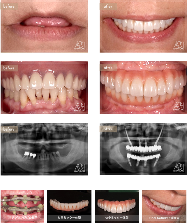 上顎は両側Zygoma、前方Nobel Active2本埋入。下顎Speedy Groovyインプラントを4本埋入。上顎はセラミック一体型、下は基 底面セラミック人工歯タイプ。