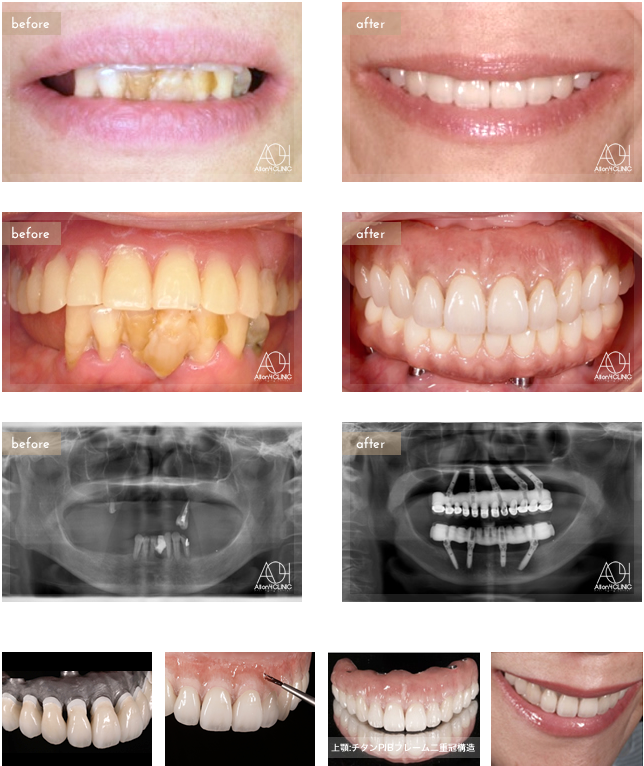 上顎は5本のインプラントを埋入。下顎はAll-on-4。上顎上部構造は二重冠構造(歯肉:アクリリックレジン　歯:セラミック)を採用。下顎はハイブリッドタイプ(歯肉:ハイブリッドセラミック 歯:ハイブリッドセラミック)。 上顎はチタンPIBフレーム。下顎チタンPIBフレーム。