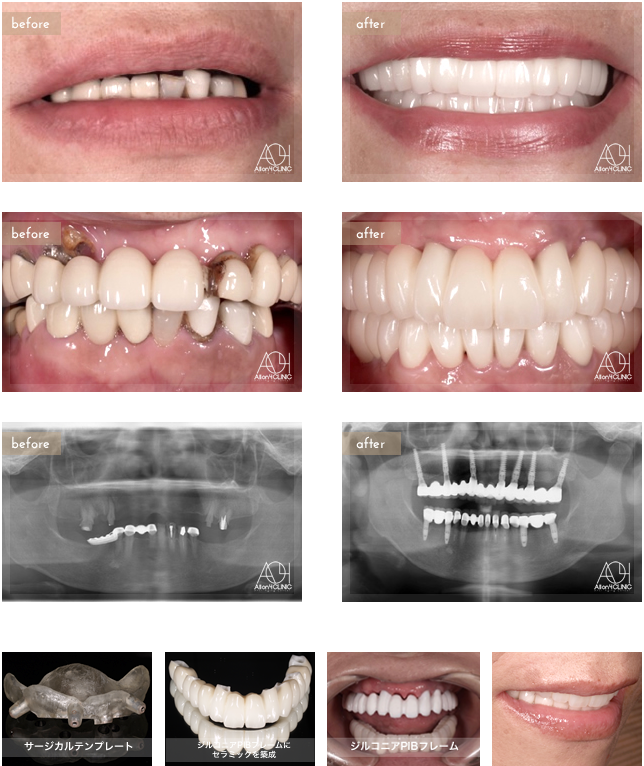 上顎は7本のNobel Activeインプラントをストレート埋入。上顎上部構造はジルコニアPIBフレームにセラミックを築成。non gumタイプを採用。上下メタルフリーによるフルマウスリコンストラクション。
